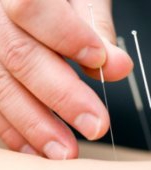 Sustinere pentru tratament prin acupunctura