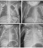 Sindromul de detresa respiratorie la prematuri