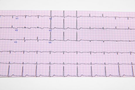 Totul despre aritmia cardiaca