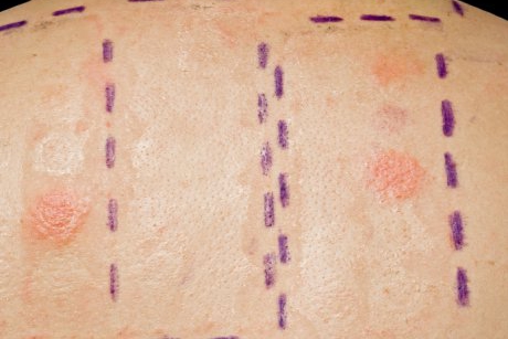 Totul despre testarea alergologica cutanata