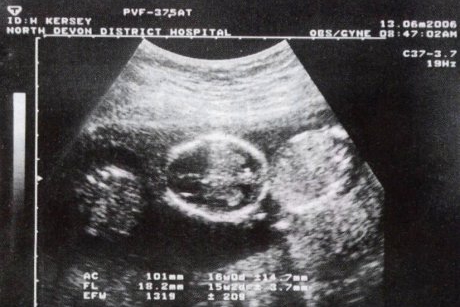 O femeie, o sarcina, 2 utere, 3 bebelusi