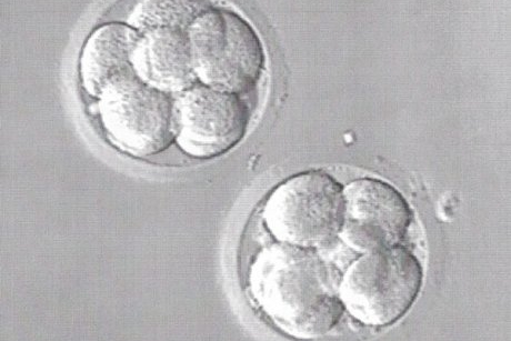 Dupa tratamentele de fertilizare, sotia mea a ramas insarcinata cu tripleti, dar a vrut sa avorteze doi dintre ei