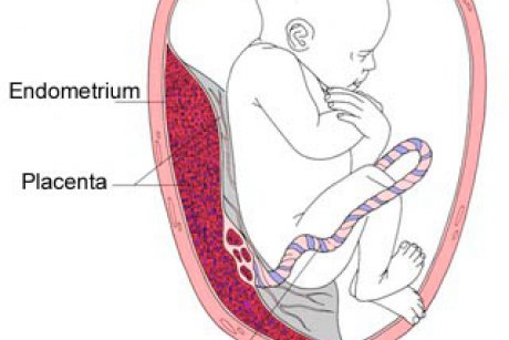 Placenta Praevia - cauze, complicatii si tratament