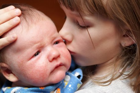 Cum să tratezi, în mod natural, eczemele bebelușului