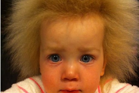 Cum arată fetiţa care suferă de sindromul părului care nu poate fi pieptănat 