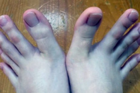 Cele mai ciudate degete de la picioare din lume 