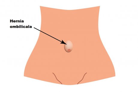 Hernia ombilicală după sarcină