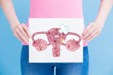 Chist ovarian. Ce este si cum se trateaza. Cat pot fi de periculoase niste chisturi ovariene