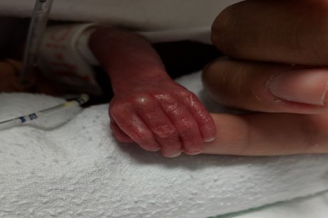 Se întâmplă miracole! Bebelușul născut cu mâna cât o monedă a sărbătorit primul an de viață