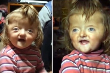 O fetiță de 2 ani nu a fost primită la creșă pe motiv ca înfățișarea ei sperie copiii
