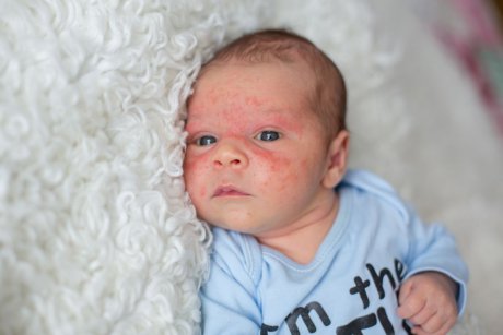 Ce trebuie să știi despre acneea bebelușului