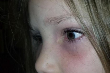 Atenție, părinți! O mamă a găsit un gândac în ochiul fiicei sale
