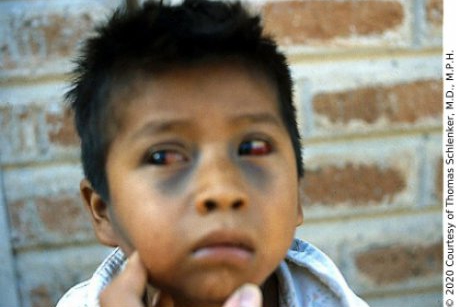 Priviți ochii acestui copil: a tușit până a leșinat! Avertisment de la Dr. Mihai Craiu