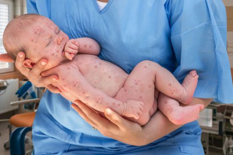 Varicela la bebeluși: cauze, simptome, tratament