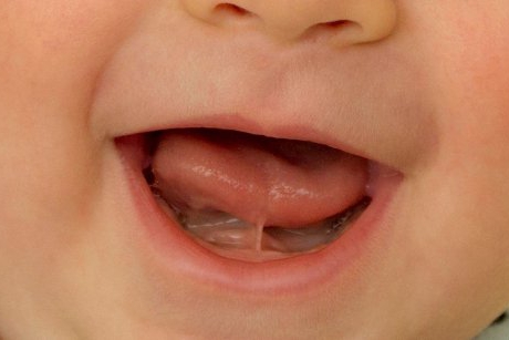 Ce este frenul lingual și cum afectează dezvoltarea bebeușului
