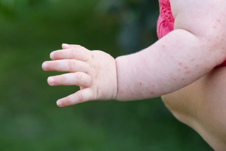 Rujeola se extinde din cauza restricţiilor care afectează vaccinările! Cel mai mare număr de cazuri din ultimii 23 de ani