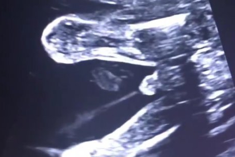 Moment unic surprins la ecograf: bebeluș făcând pipi în uterul mamei lui