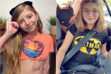 Fetiţa care trăieşte cu inima în afara pieptului a împlinit 11 ani și duce o viață normală! Medicii nu i-au dat nicio șansă