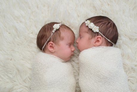 Emoție pură! Două gemene siameze s-au privit pentru prima dată în ochi după ce au trecut printr-o operație de 16 ore