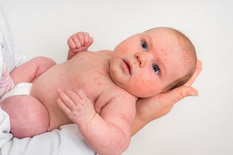 Alergia la bebeluși: cauze, simptome, tratament