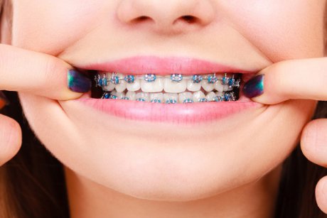 Aparatul dentar pentru copii: avantaje, tipuri și recomandări