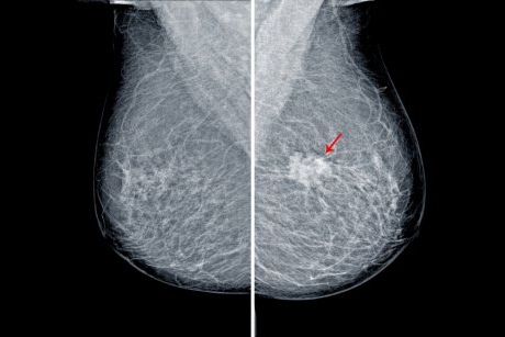 Microcalcificări la sân: ce sunt și când ar trebui să te îngrijoreze