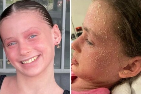 O fetiță de 11 ani este alergică la propriile lacrimi și transpirație