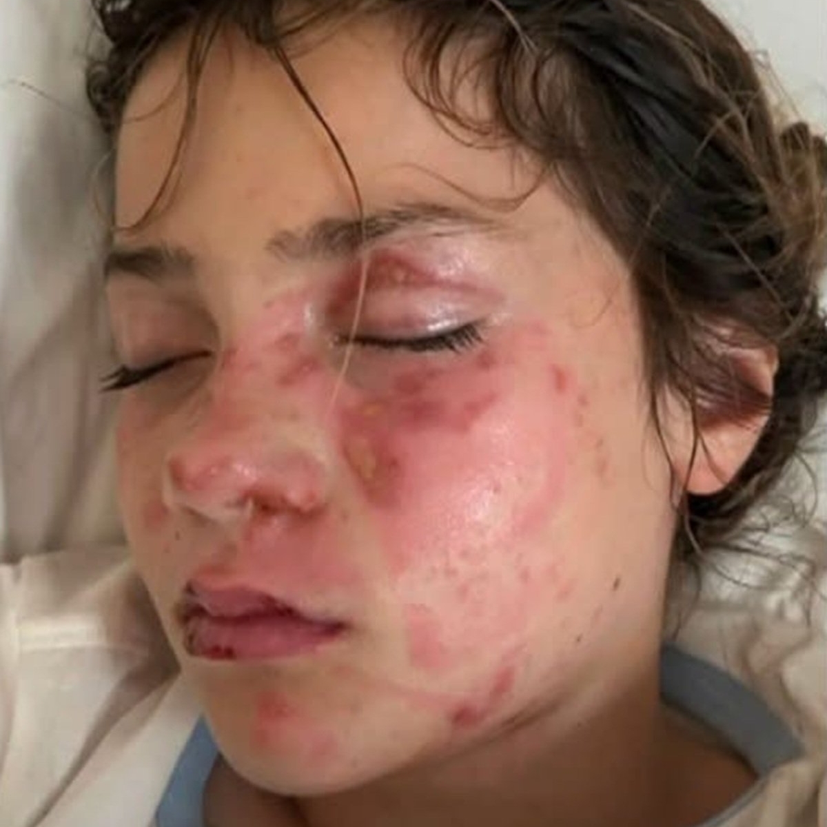 Atenție la trendurile de pe TikTok! O fetiță de 10 ani a suferit arsuri extrem de grave la nivelul feței după ce a pus o jucărie de plastic la microunde