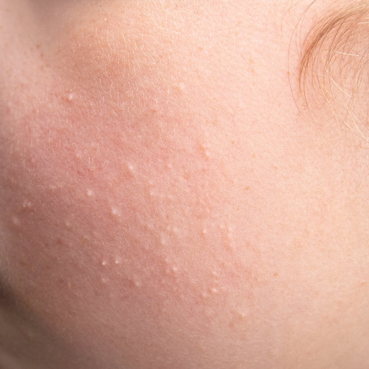 Hiperplazie sebacee: cauze, simptome și tratament