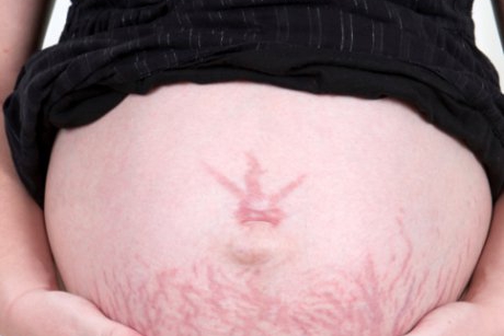 Vergeturile: cauze si tratamente naturiste