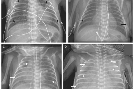 Sindromul de detresa respiratorie la prematuri