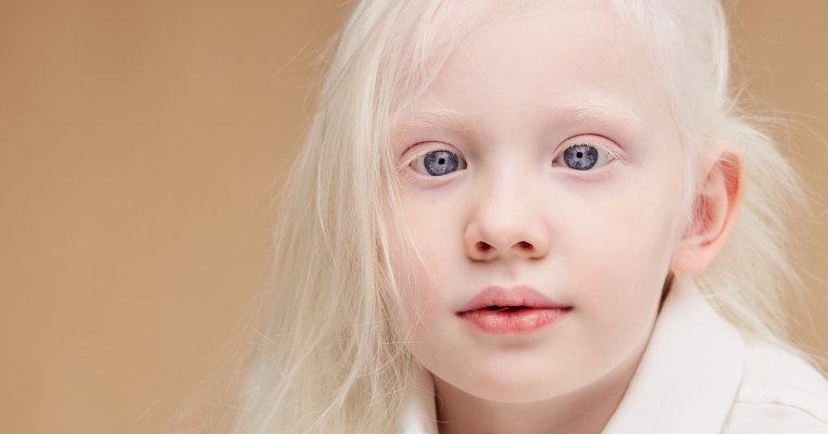 viziune cu albinism