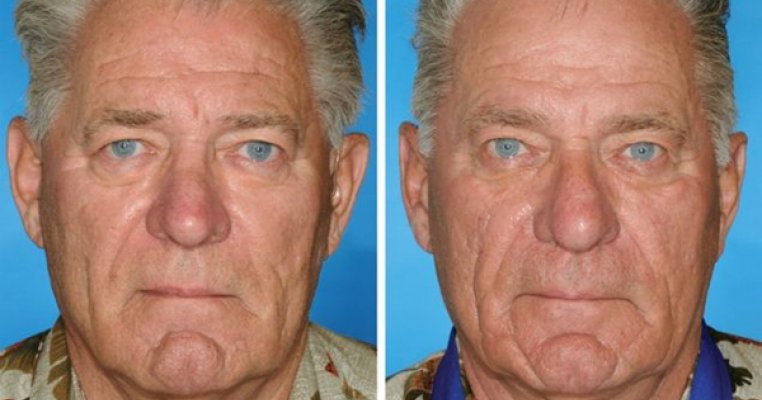 Fotografii socante arata efectele devastatoare ale fumatului  