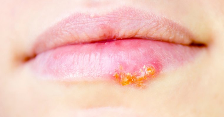 Totul Despre Herpes