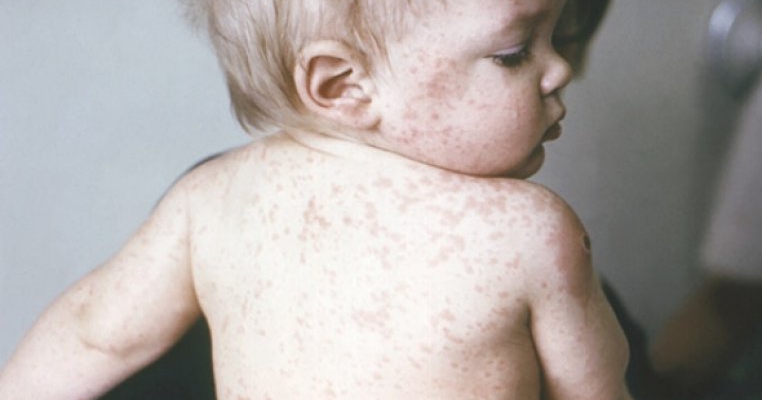 Epidemia de rujeola din SUA confirma: Vaccineaza-ti copilul!