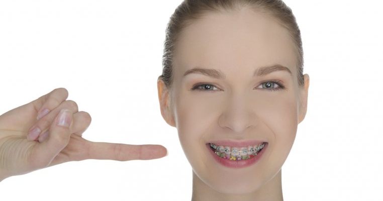 6 mituri despre aparatele dentare