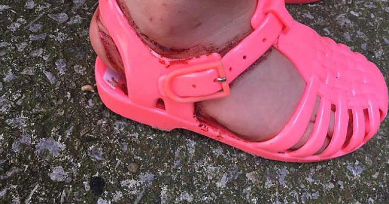Mare grijă la săndăluțele de plastic pentru copii. Iată ce a pățit această fetiță