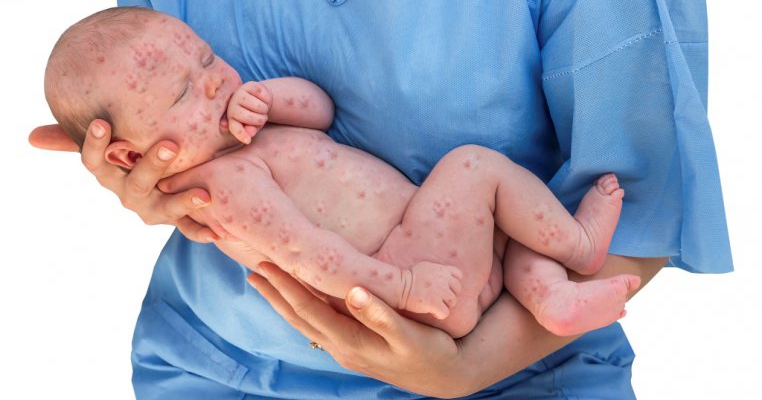Virusul Herpetic Qbebe Ro Virusul Herpetic Qbebe Ro
