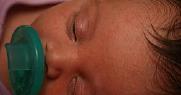 Acneea la bebelusi: 8 intrebari care ii preocupa pe parinti