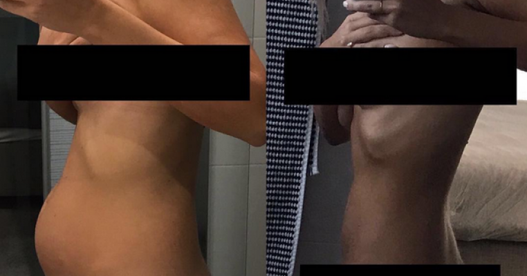 Fotografia reală care dezvăluie realitatea cruntă a endometriozei