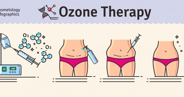 Ce este ozonoterapia? 