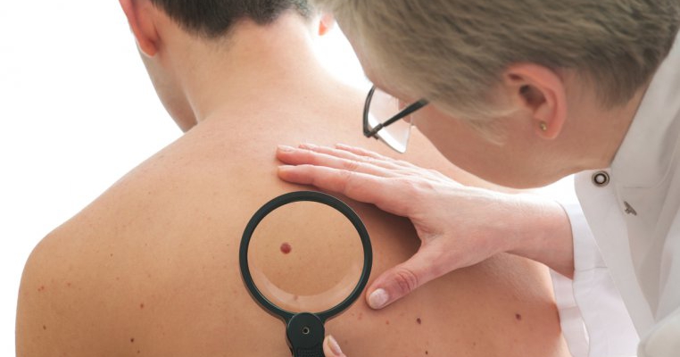 Cum îţi dai seama dacă aluniţele tale sunt cancerigene