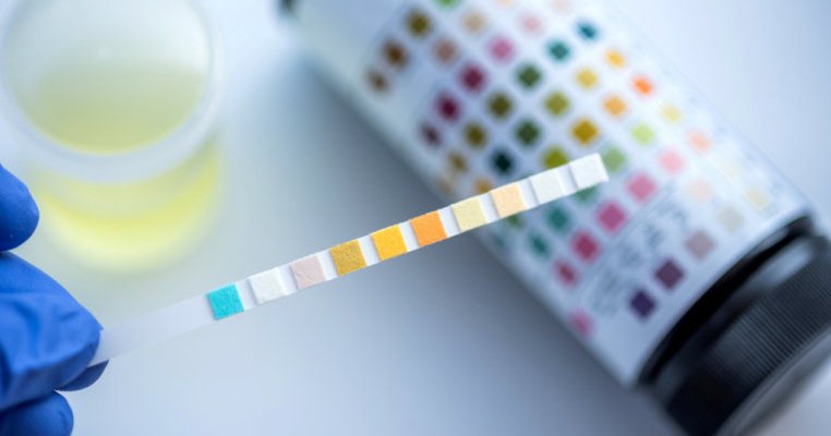 Analiza biochimică a urinei (cu sediment urinar) - Invitro Diagnostics