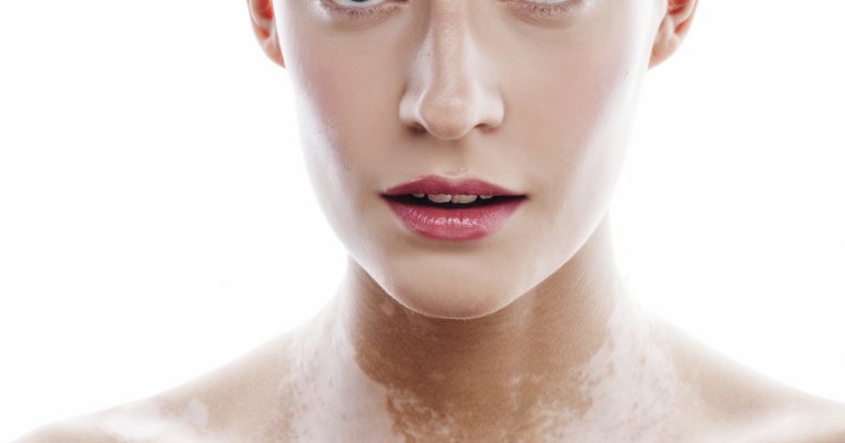 Ce trebuie să știi despre vitiligo
