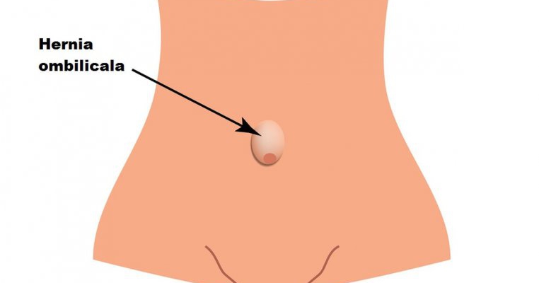 Hernia ombilicală în timpul sarcinii - Naştere June