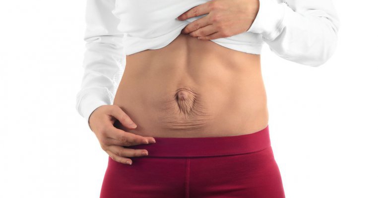 Diastazis de mușchi abdominal drept: efectul advers al unei sarcini cu un bebeluș foarte mare