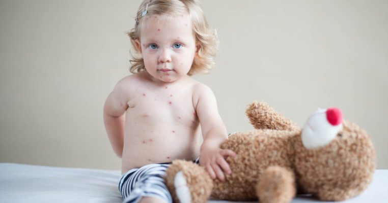 Părinții anti-vaccinare organizează petreceri pentru a-și îmbolnăvi copiii cu varicelă!