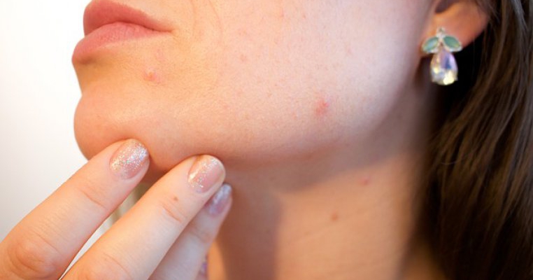 Puncte negre si cosuri? Iata 9 remedii naturale pentru toate tipurile de ten