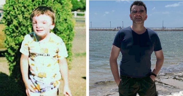 Cum arată acum bebelușul respins de părinți pentru că era prea urât