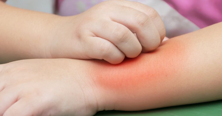 Ghid de la dermatolog: cum recunoști bolile de piele ale copilului